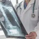 A quel âge peut survenir un cancer des os